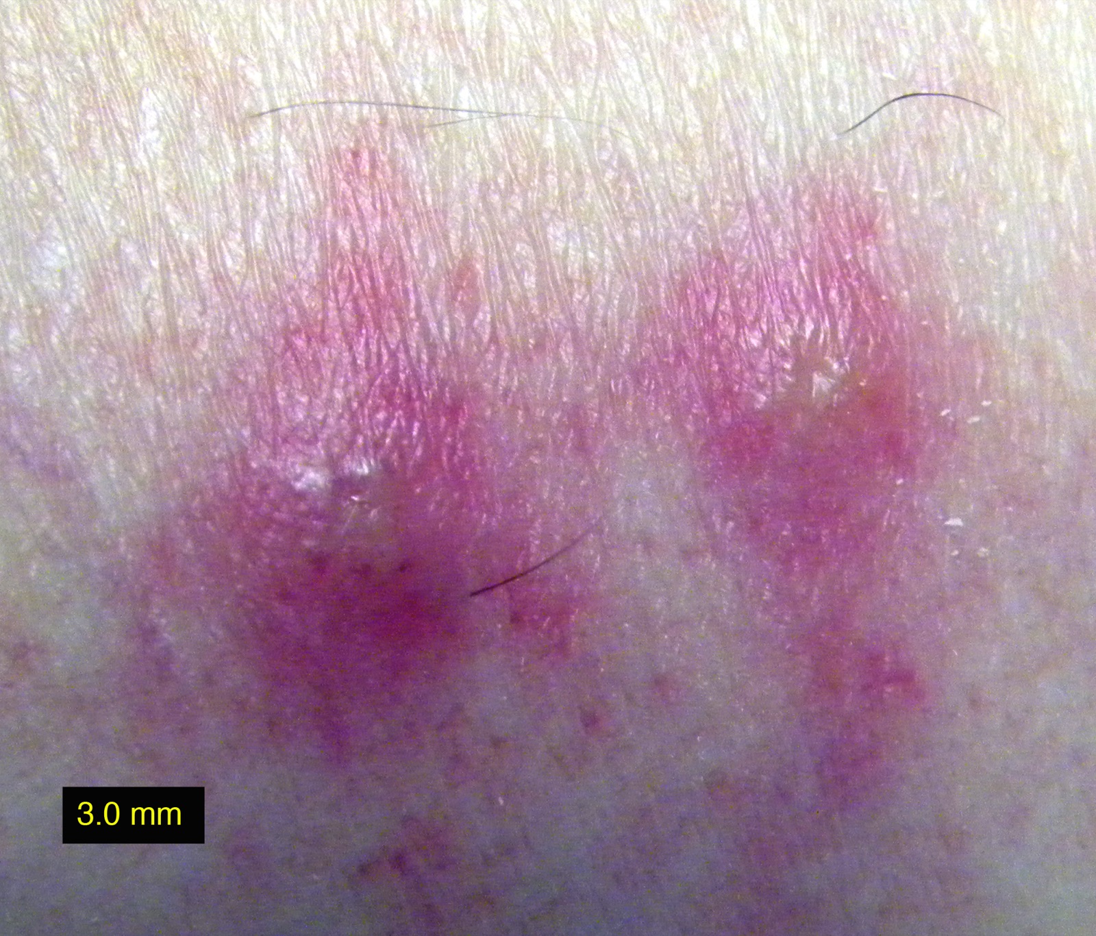 Cluster of red chigger bite welts on a person's ankle, photographed in Alabama